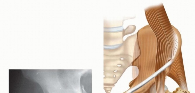 Achieve Optimal Femoral Head Fixation with Cephalomedullary Nailing