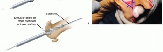 Illustration 21 for End Articular Cartilage Loss: Arthrosurface HemiCAP Resurfacing