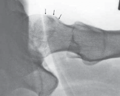 Illustration 5 for FAI: Impingement and Surgical Dislocation Explained