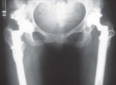 Illustration 104 for Successful Total Hip Replacement in Developmental Dysplasia