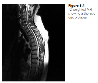 Illustration 2 for Don't Miss Cauda Equina Syndrome: Red Flags in Disc Prolapse