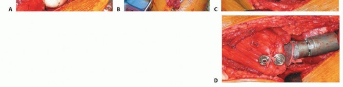 Illustration 21 for Regain Mobility: Total Hip Arthroplasty for Malignant Lesions