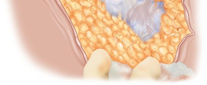 Illustration 3 for Unlock the Figure Posterior Approach to the Hip