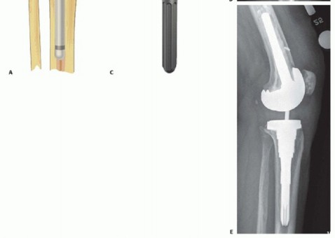 Illustration 3 for Tibial Bone Loss in TKA Revision: Augments for Complex Cases