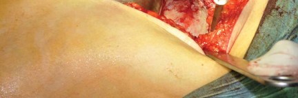 Illustration 16 for Collum Femoris Preserving: Achieve Better Primary Hip Outcomes