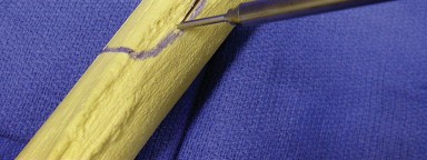 Illustration 21 for Achieving Success with Trochanteric Osteotomy Posterior for Revision