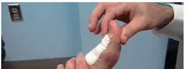 Illustration 54 for End Articular Cartilage Loss: Arthrosurface HemiCAP Resurfacing