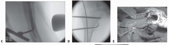 Illustration 17 for Achieve Optimal Femoral Head Fixation with Cephalomedullary Nailing
