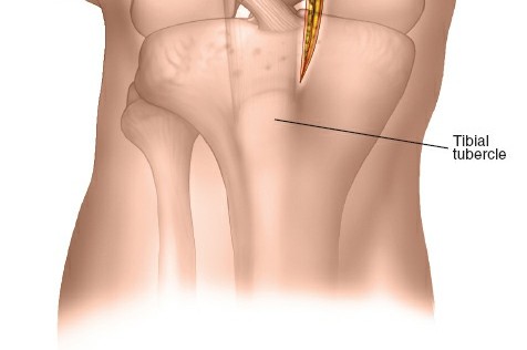 Illustration 78 for Optimal Femoral Approaches: Mastering the Lateral Intermuscular Septum