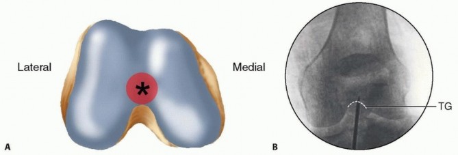 Retrograde Femoral Nailing: Optimizing Surgical Outcomes
