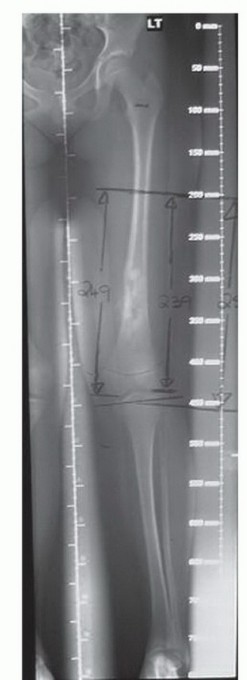 Illustration 3 for Expandable Prostheses: Understanding Infection Risk for Young Patients