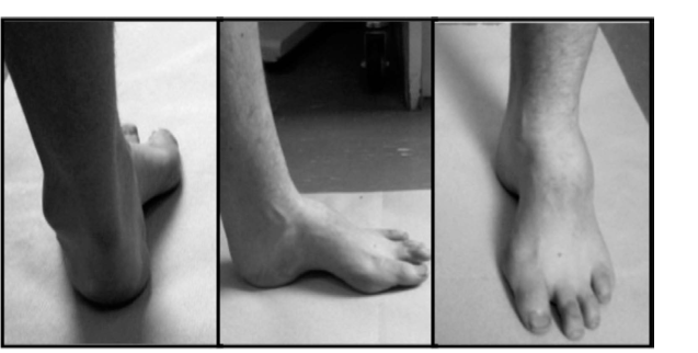 Cavus Foot Examination Question: Ace Your Oral Exam Prep