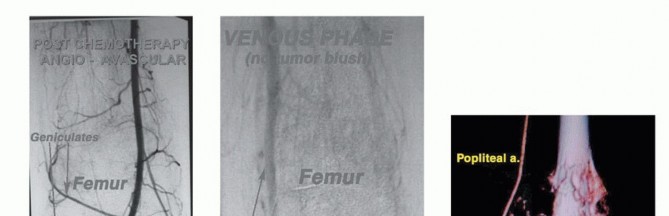 Illustration 15 for Advanced Distal Femoral Resections: Limb-Sparing Outcomes & Techniques