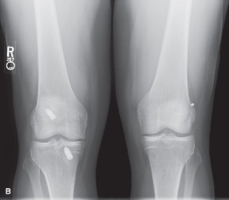 Illustration 2 for Female Athlete Triad: Diagnosing Critical Sports Medicine Cases