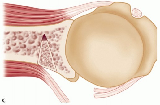 Illustration 34 for Finally Treat Recurrent Posterior Instability of the Shoulder