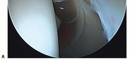 Illustration 23 for Hip Arthroscopy: Your Minimally Invasive Solution for Hip Pain