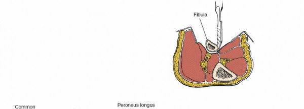 Illustration 101 for Surgical Access: Mastering the Tibia's Surface & Fibula Approaches