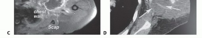 Illustration 8 for Axillary Space Exploration: Surgical Resection of Complex Tumors
