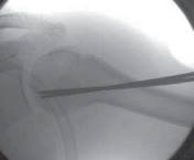 Illustration 16 for Mastering Pediatric Shoulder Fractures: Clinical Insights