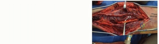 صورة توضيحية لـ الورم الغضروفي الداخلي (Enchondroma): دليل شامل للمرضى مع الأستاذ الدكتور محمد هطيف في صنعاء