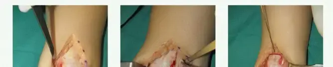 آفات الكاحل الغضروفية العظمية: دليل شامل للمرضى نحو التعافي في اليمن والخليج العربي