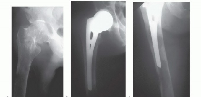 Illustration 2 for Plain Radiograph Showing MBD: Surgical Planning to Prevent Failures