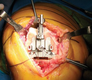 Illustration 13 for Minimally Invasive Subvastus: The Best Path to Quicker TKA Recovery