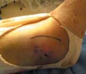 Illustration 24 for Optimal Fixation of the Ankle: Open Reduction & Internal Fixation