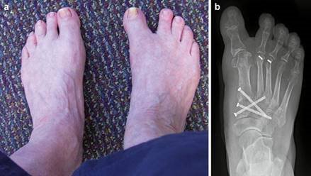 Illustration 67 for First Metatarsal Surgery: Expert Solutions for Foot & Ankle Pain