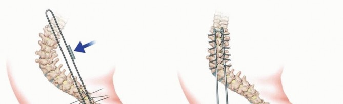 Illustration 28 for Duchenne Muscular Dystrophy: Is Spinal Fusion the Answer?