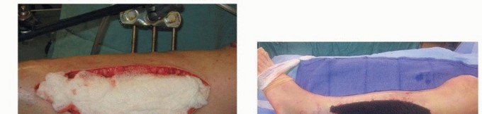 Illustration 22 for Acute Compartment Syndrome: Timely Fasciotomy Explained