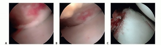 Illustration 10 for Regain Stability: Arthroscopy for Anterior Instability & the Inferior Glenohumeral Ligament