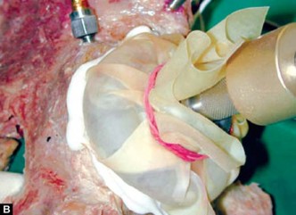 Illustration 22 for Optimizing Acetabular Component Cementation for Superior Outcomes