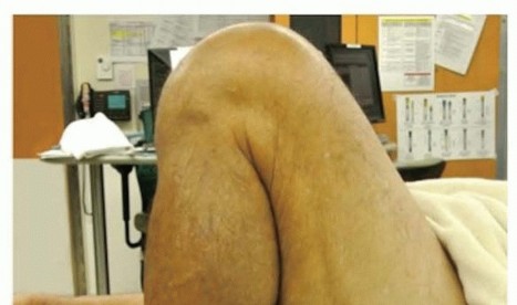 صورة طبية: استبدال مفصل الركبة الجزئي: حل متقدم لآلام الركبة المستمرة مع الأستاذ الدكتور محمد هطيف