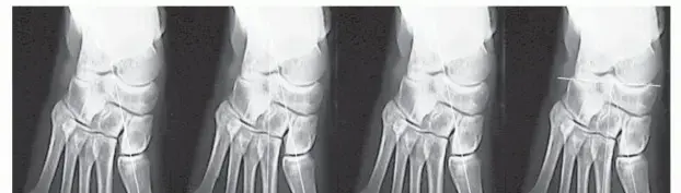 إبهام القدم الأروح (الوكعة): دليل شامل للعلاج والتعافي مع الأستاذ الدكتور محمد هطيف في صنعاء