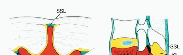 Illustration of total en bloc - Dr. Mohammed Hutaif