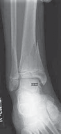 Illustration 4 for Pediatric Ankle Fractures: Management to Prevent Long-Term Issues