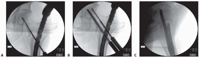 Illustration 28 for Achieve Optimal Femoral Head Fixation with Cephalomedullary Nailing