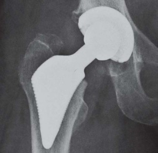 Illustration 44 for The Proxima: Why This Proximally Loading Implant Preserves Bone