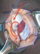 Illustration 20 for Unlocking Mobility: Distal Lengthening for Lateral Hamstring Muscle