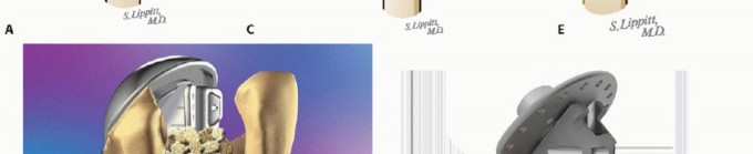 Illustration 30 for Hemiarthroplasty for Proximal: Effective Treatment for Fractures