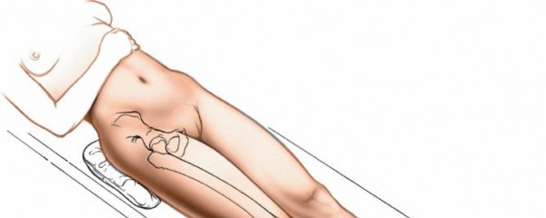 Illustration 7 for Unlocking Every Aspect of the Hip's Surgical Approaches