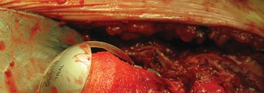 Illustration 51 for Figure Hip Resurfacing: Who Benefits and Who Should Avoid It?