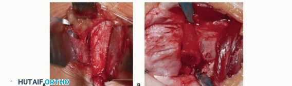 Illustration 17 for Precision Correction for Distal Radius Malunion