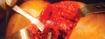 Illustration 38 for The Silent Hip: Achieving a Truly Silent, Pain-Free Joint