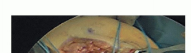 Illustration 6 for Repair & Recover from Collateral Ligament Injuries: Your Guide