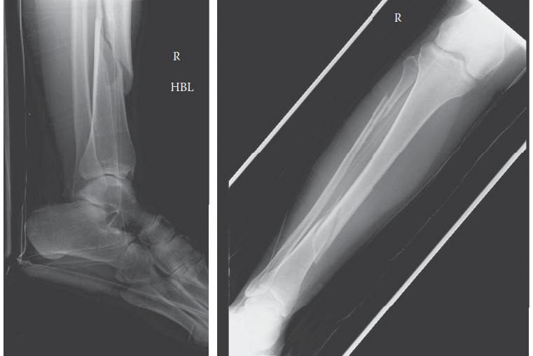 Trauma Case Compartment Syndrome: Spotting the Red Flags