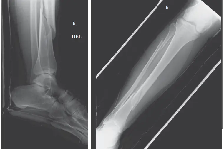 متلازمة الحيز الحادة: الدليل الشامل للتشخيص والعلاج مع الأستاذ الدكتور محمد هطيف في صنعاء