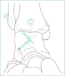 Illustration 1 for Mastering Foot & Ankle Interventions: Essential Ankle Surgery Insights