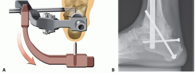 Illustration 33 for Unlock Stability: Medullary Nail Fixation for Tibiotalocalcaneal Arthrodesis